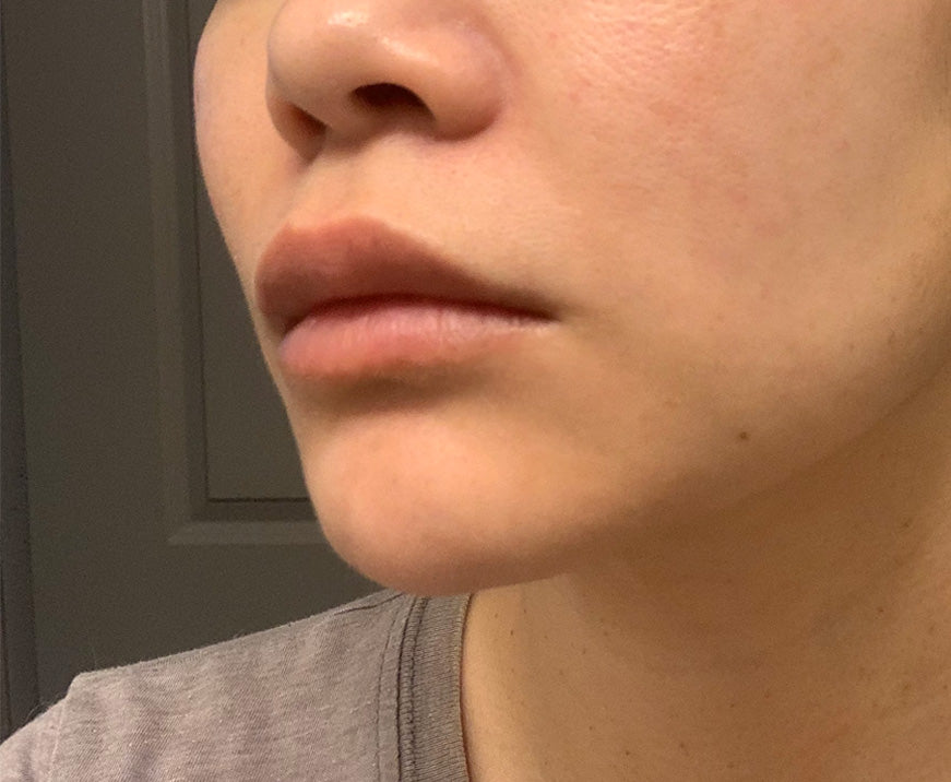 Chin Filler - What I think worked best for my facial balance