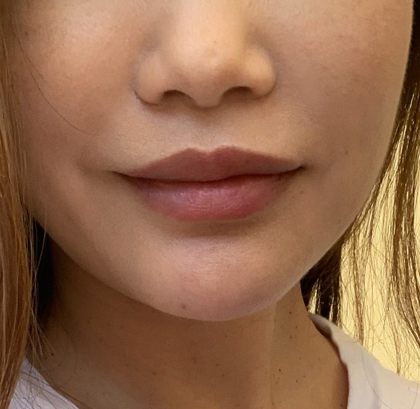 What is a Lip Lift?